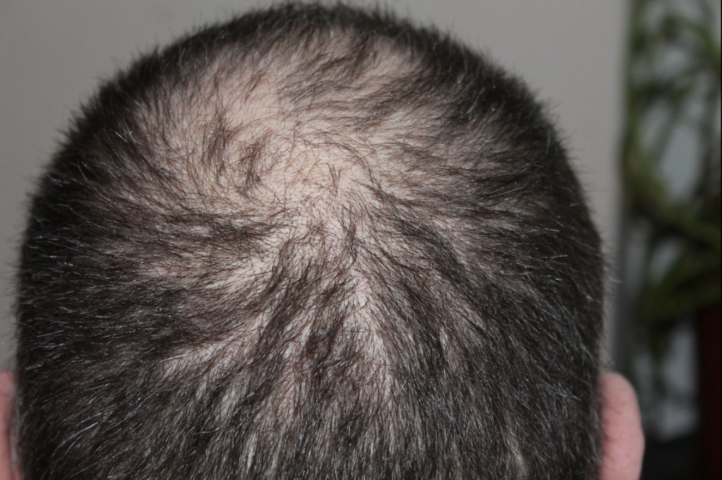Alopecie androgenetique