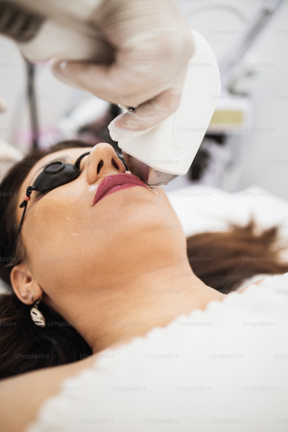 Épilation Laser et Hyperandrogénie : Une Approche Spécifique pour les Zones Hormonodépendantes
