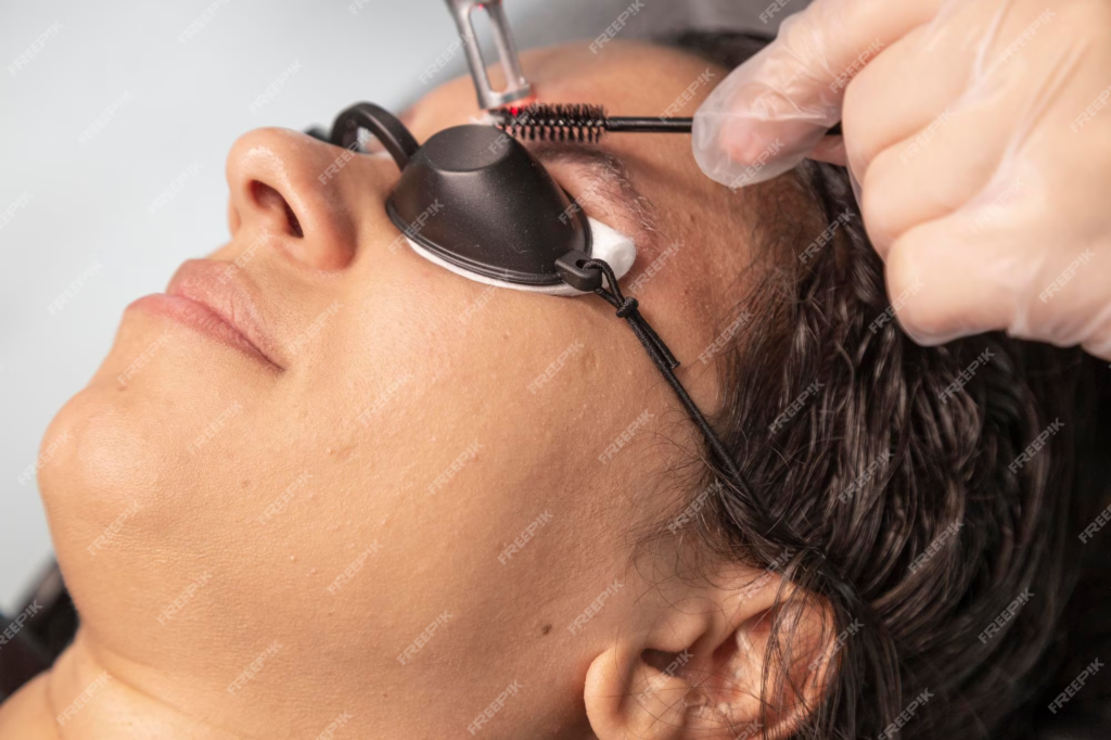 Détatouage  laser du maquillage semi-permanente et microblading sourcils