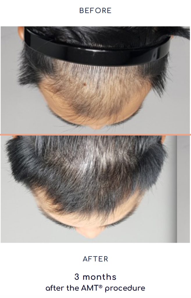 Rigenera Hair Mesograft