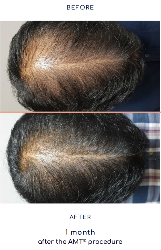 Rigenera Hair Mesograft