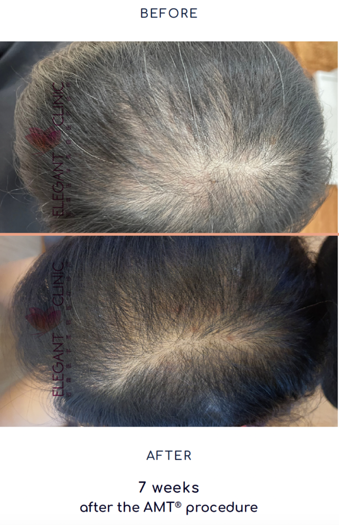 Rigenera Hair Mesograft