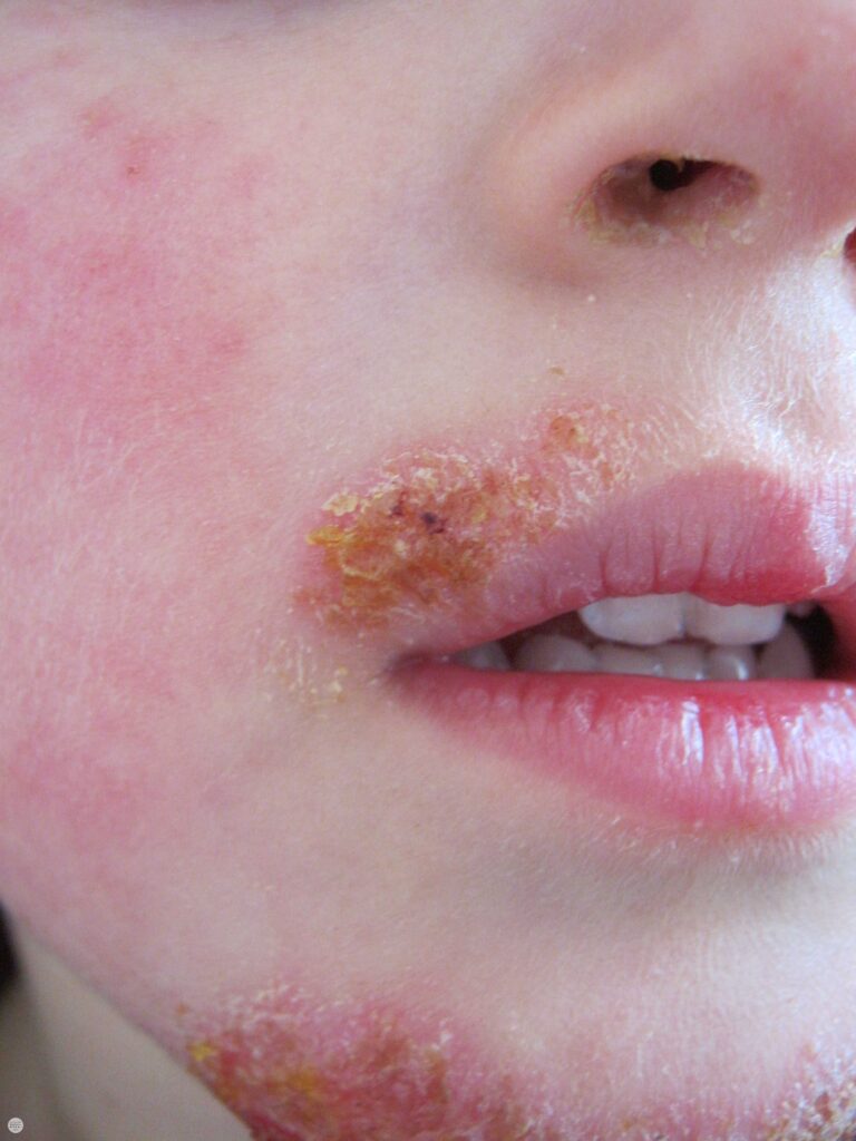 Impetigo