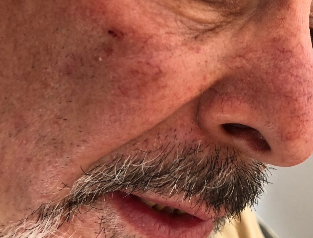 rosacea erythemato-telangiectatic or rosacea