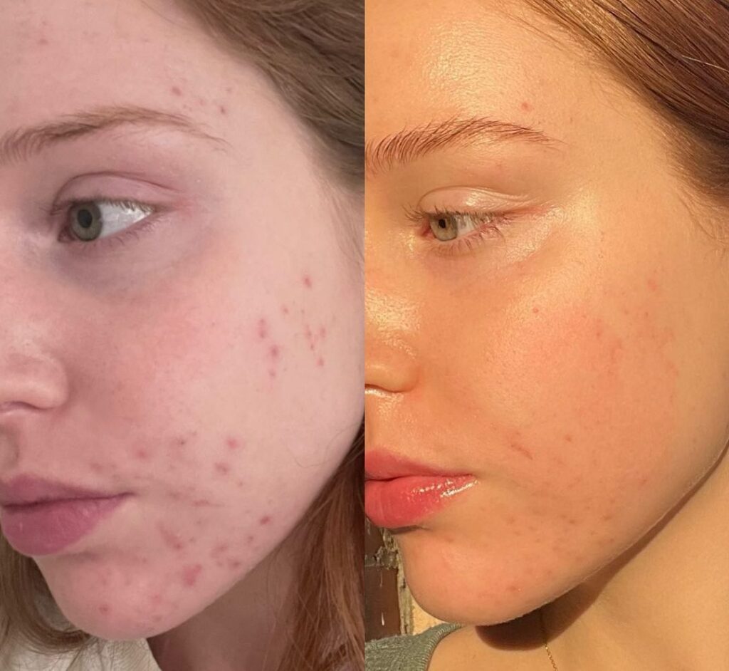 avant après hydrafacial acné