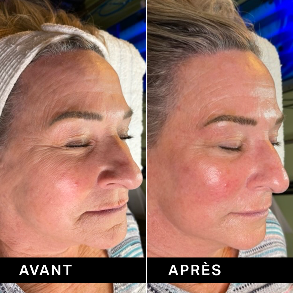 avant après hydrafacial rides